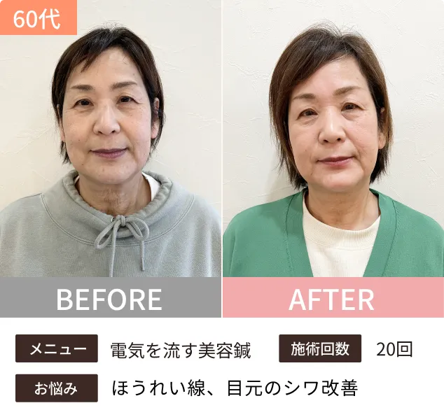 美容鍼のビフォーアフター