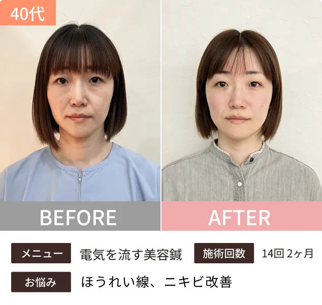 美容鍼のビフォーアフター