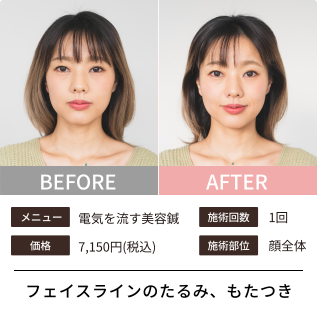 フェイスラインのたるみ、もたつき