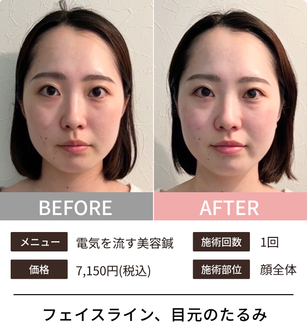 美容鍼のビフォーアフター