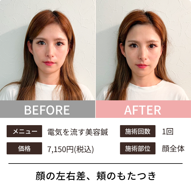 美容鍼のビフォーアフター