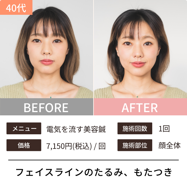 フェイスラインのたるみ、もたつき