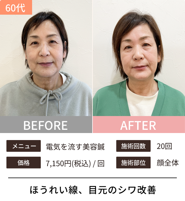 美容鍼のビフォーアフター