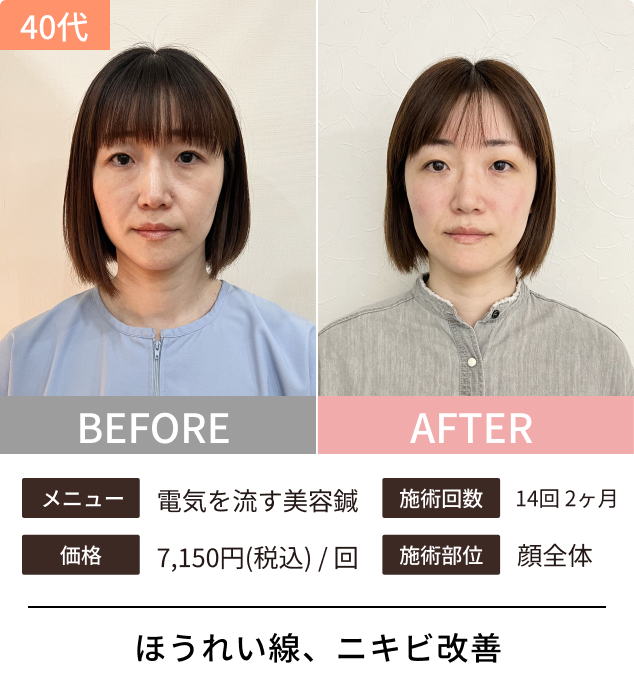 美容鍼のビフォーアフター